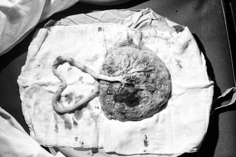 Placenta Development Location Complications PH