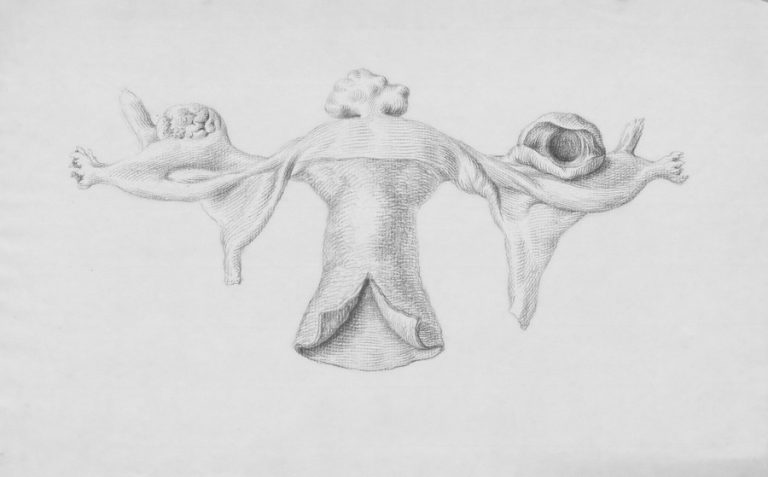 Uterus Removal Hysterectomy BGC