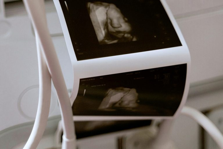 Breech baby position pregnancy