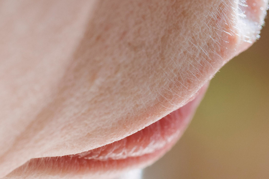 Hirsutism Philippines Manila Clinic