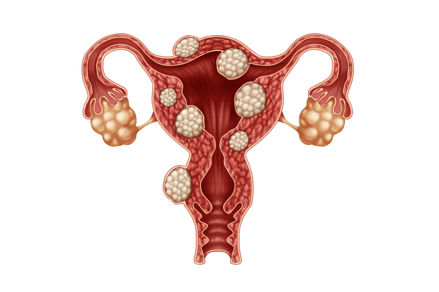 Uterine Fibroids Clinic Doctor